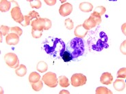 Bone marrow granulomas secondary to Histoplasmosis sepsis - 1.