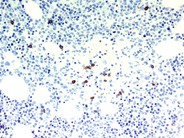 Bone marrow granulomas secondary to Histoplasmosis sepsis - 10.