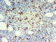 Bone marrow granulomas secondary to Histoplasmosis sepsis - 9.