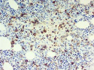 Bone marrow granulomas secondary to Histoplasmosis sepsis - 9.