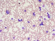 T-cell prolymphocytic leukemia - 1.