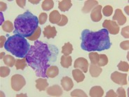 T-cell prolymphocytic leukemia - 3.