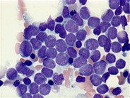 AML, minimally differentiated - 1.