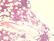 CLL – nodular pattern - 1.