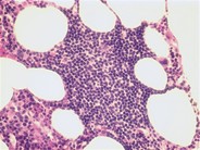 CLL – nodular pattern - 2.
