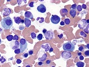 Look-alikes: plasma cells vs. erythroid precursors - 1.