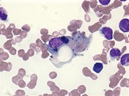 Erythrophagocytosis - 2.