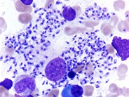 LD body infestation in bone marrow aspirate - 1.