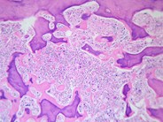 Myelofibrosis associated osteomyelosclerosis - 2.