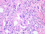 Myelofibrosis associated osteomyelosclerosis - 4.