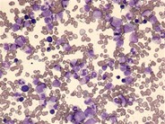 Reactive marrow – pediatric - 1.