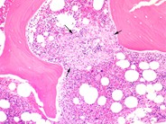 Bone marrow granuloma - 1.