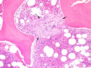 Bone marrow granuloma - 1.