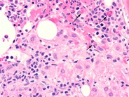 Bone marrow granuloma - 3.