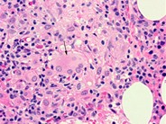 Bone marrow granuloma - 4.