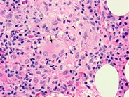 Bone marrow granuloma - 4.