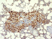 Bone marrow granuloma - 5.