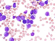 AML with t(15;17)(q22;q21), microgranular variant - 3.