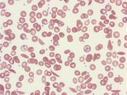 Sickle cell disease – RBC morphology - 1.