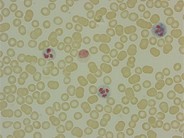 Leukocyte alkaline phosphatase (LAP)scoring - 2.