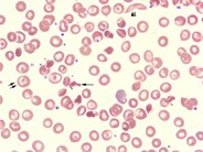 Hemoglobin SC Crystals - 2.