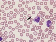 Stomatocyte - 1.