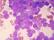 Small-cell neuroendocrine carcinoma with bone marrow and peripheral blood involvement mimicking a lymphoma in leukemic phase - 2.