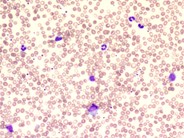 Refractory anemia with ringed sideroblast associated with thrombocytosis - 1.