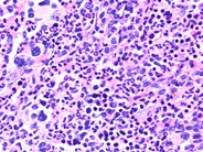 Refractory anemia with ringed sideroblast associated with thrombocytosis - 4.