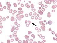 Microangiopathic hemolytic anemia - 2.