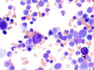 Systemic mastocytosis - 1.