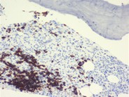 Systemic mastocytosis - 5.