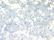 Systemic mastocytosis - 6.