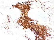 Systemic mastocytosis - 7.