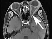Relapsed ALL–extramedullary disease - 1.