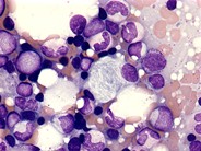 Gaucher’s disease - 1.