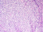 Diffuse Large B-cell Lymphoma, Anaplastic Variant - 1.