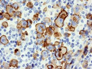 Diffuse Large B-cell Lymphoma, Anaplastic Variant - 6.