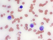 Leukemic phase of multiple myeloma - 2.
