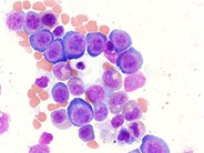 Megaloblastic anemia - 1.