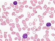 T-cell lymphoblastic leukemia - 2.