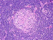 Castleman lymphadenopathy - 2.