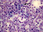 Multiple myeloma and acute myeloid leukemia - 1.