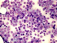 Multiple myeloma and acute myeloid leukemia - 2.