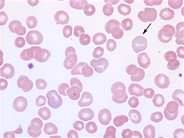 Polychromatophilic red cells - 2.