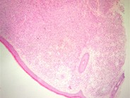 Cutaneous lesions in systemic mastocytosis - 1.