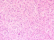 Cutaneous Lesions In Systemic Mastocytosis - 1.