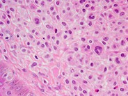 Cutaneous lesions in systemic mastocytosis - 3.