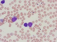 Adult T-cell leukemia/lymphoma peripheral smear - 2.