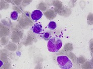 Leishmaniasis in bone marrow aspirate - 1.